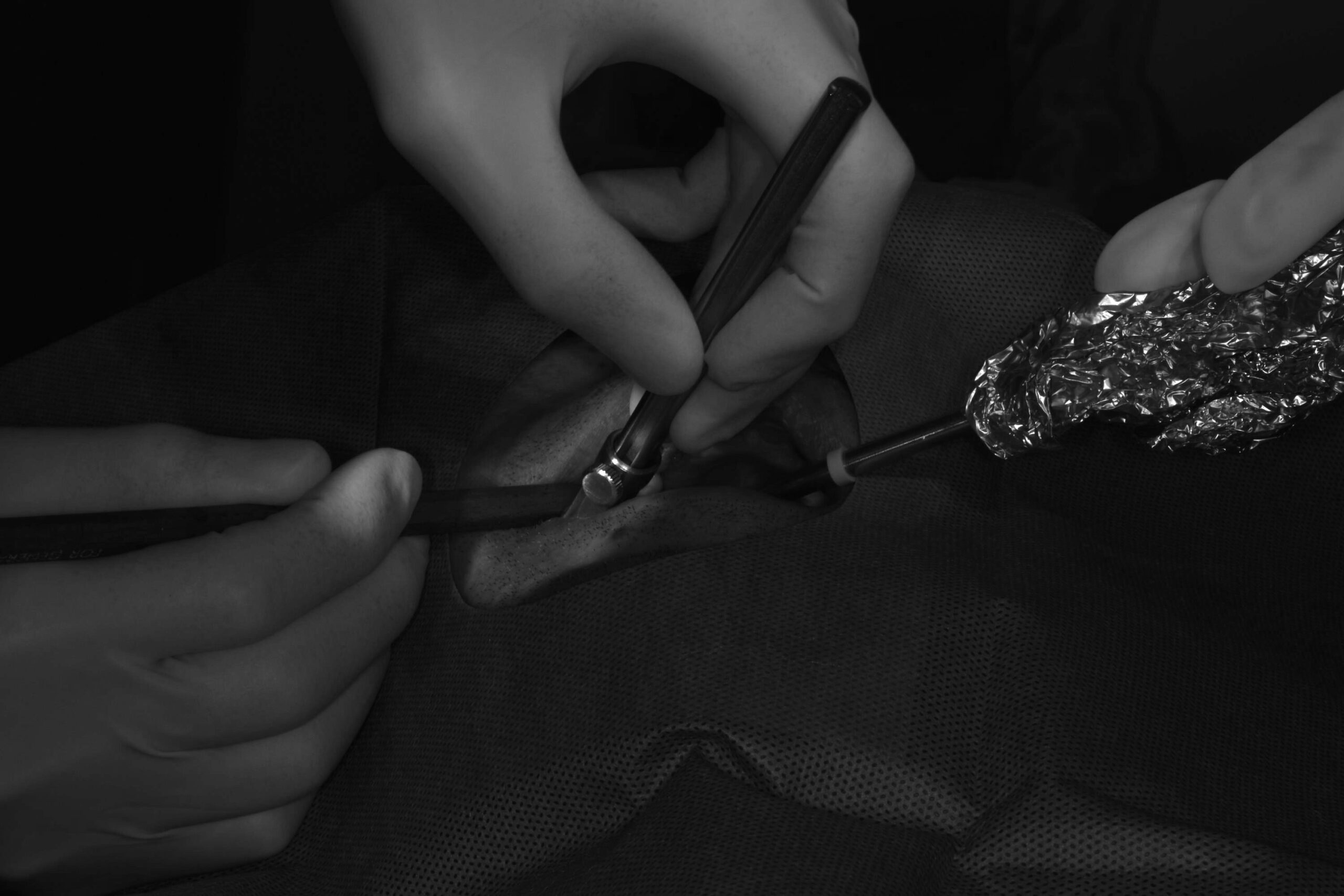 右上５番インプラント１次埋入オペ＃075 画像