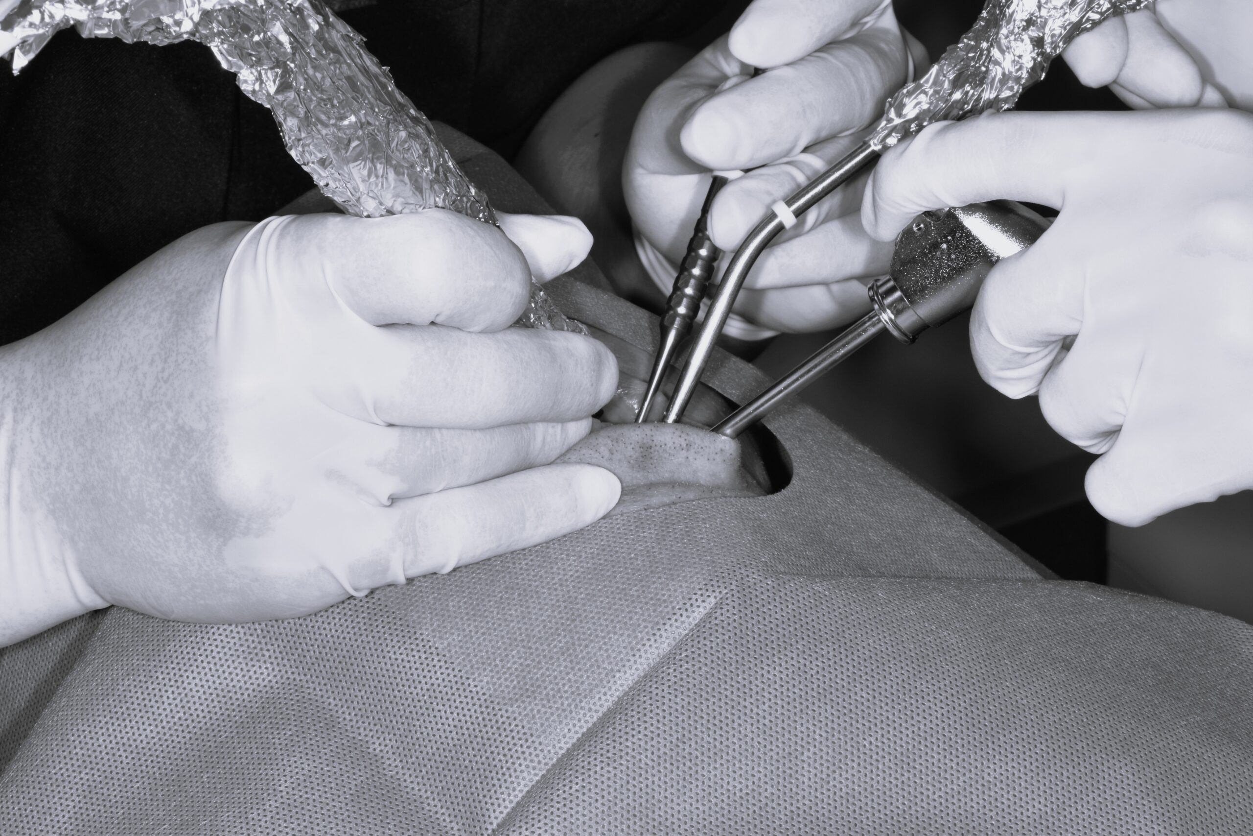 左下５番インプラント一次埋入オペ　＃073 画像