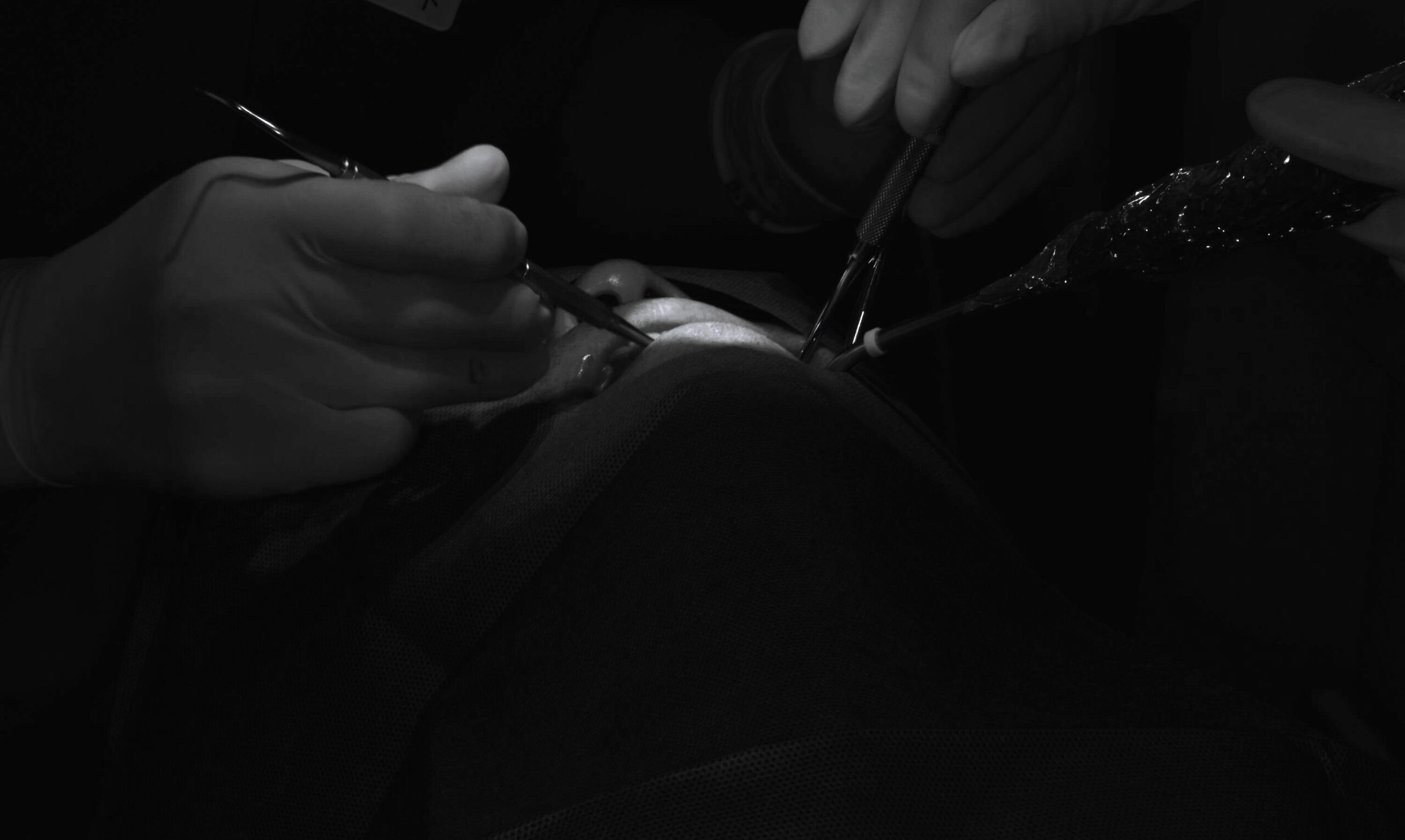 左上5番インプラント一次埋入オペ　＃081 画像