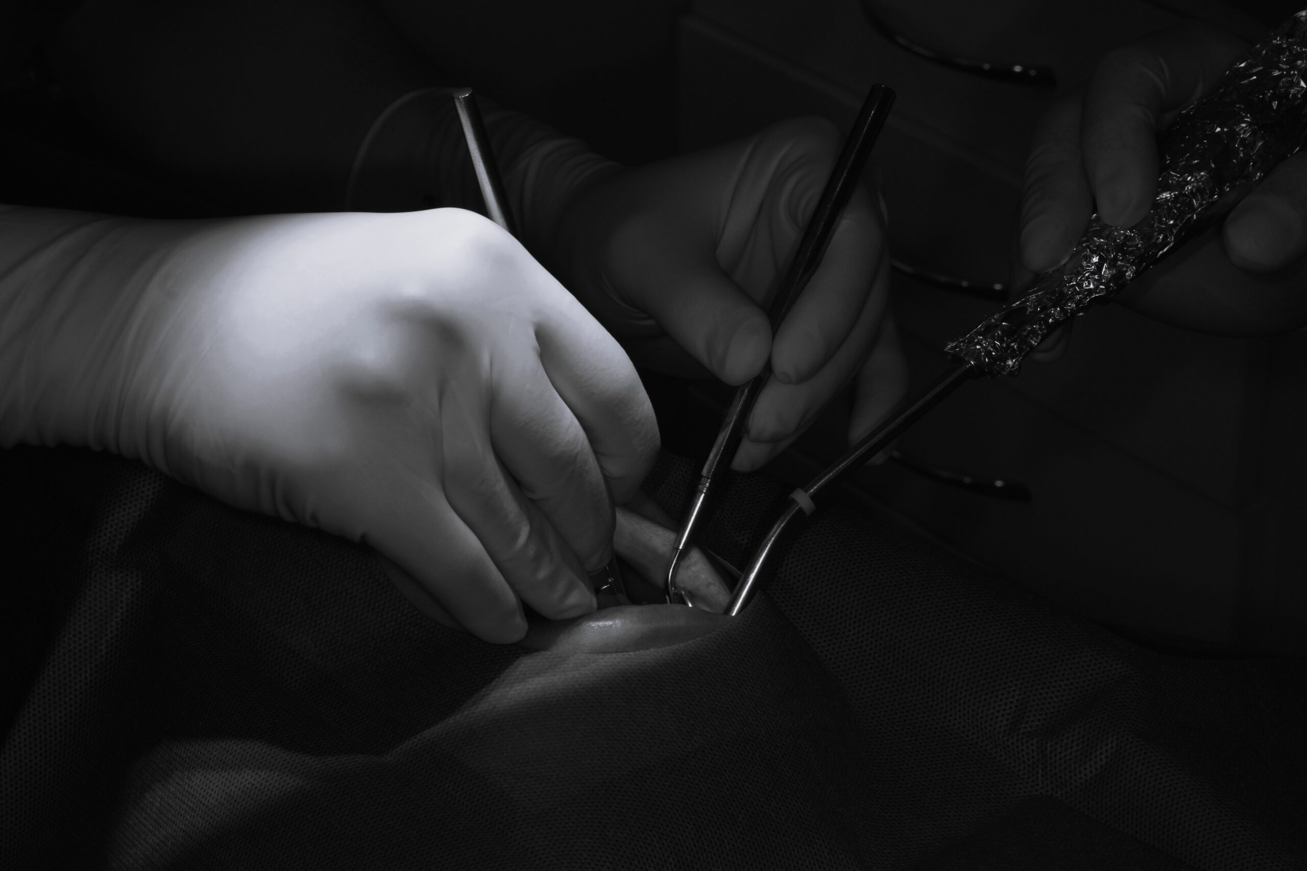 左下5.6番インプラント一次埋入オペ　＃082 画像