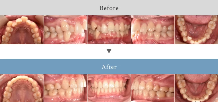 ワイヤー矯正で歯並び（叢生）の改善（ホワイトニング併用）#016