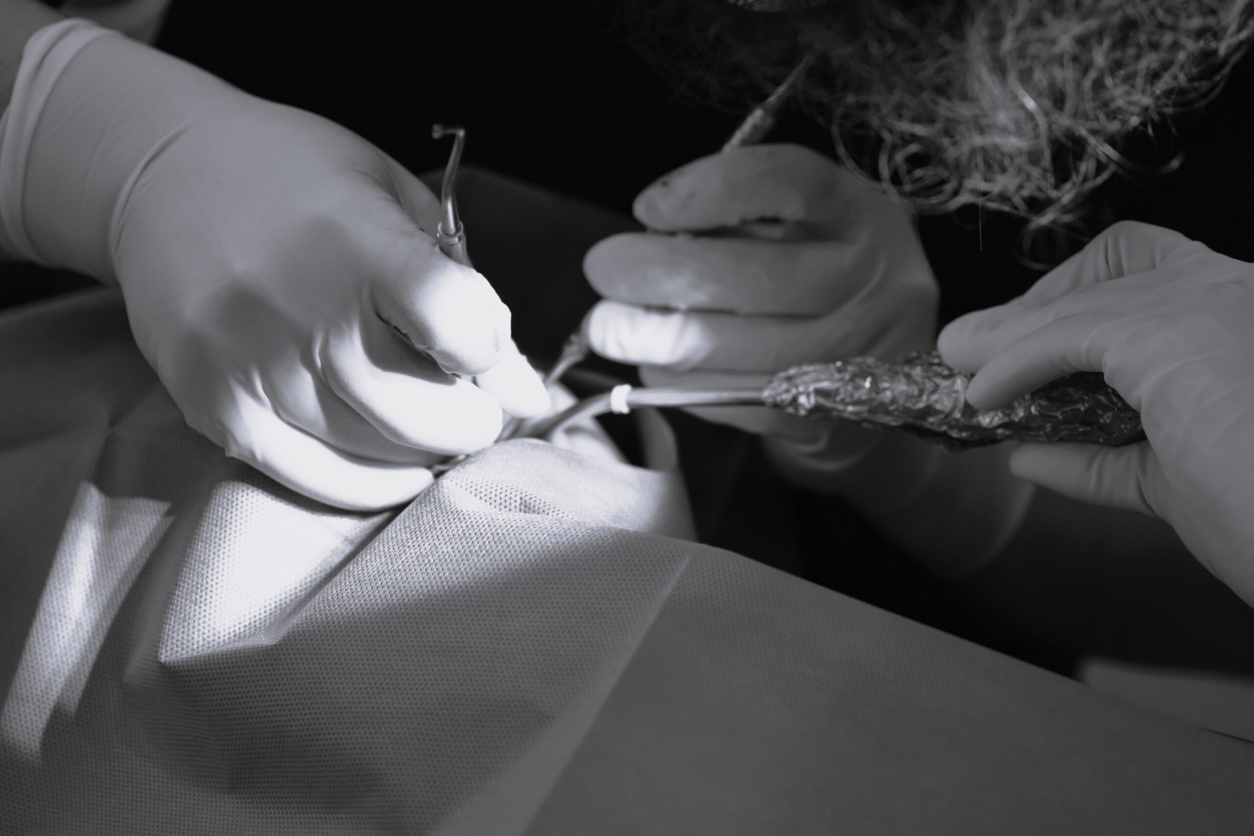 左上４番、６番、ソケットリフト、インプラント一次埋入オペ　＃093 画像