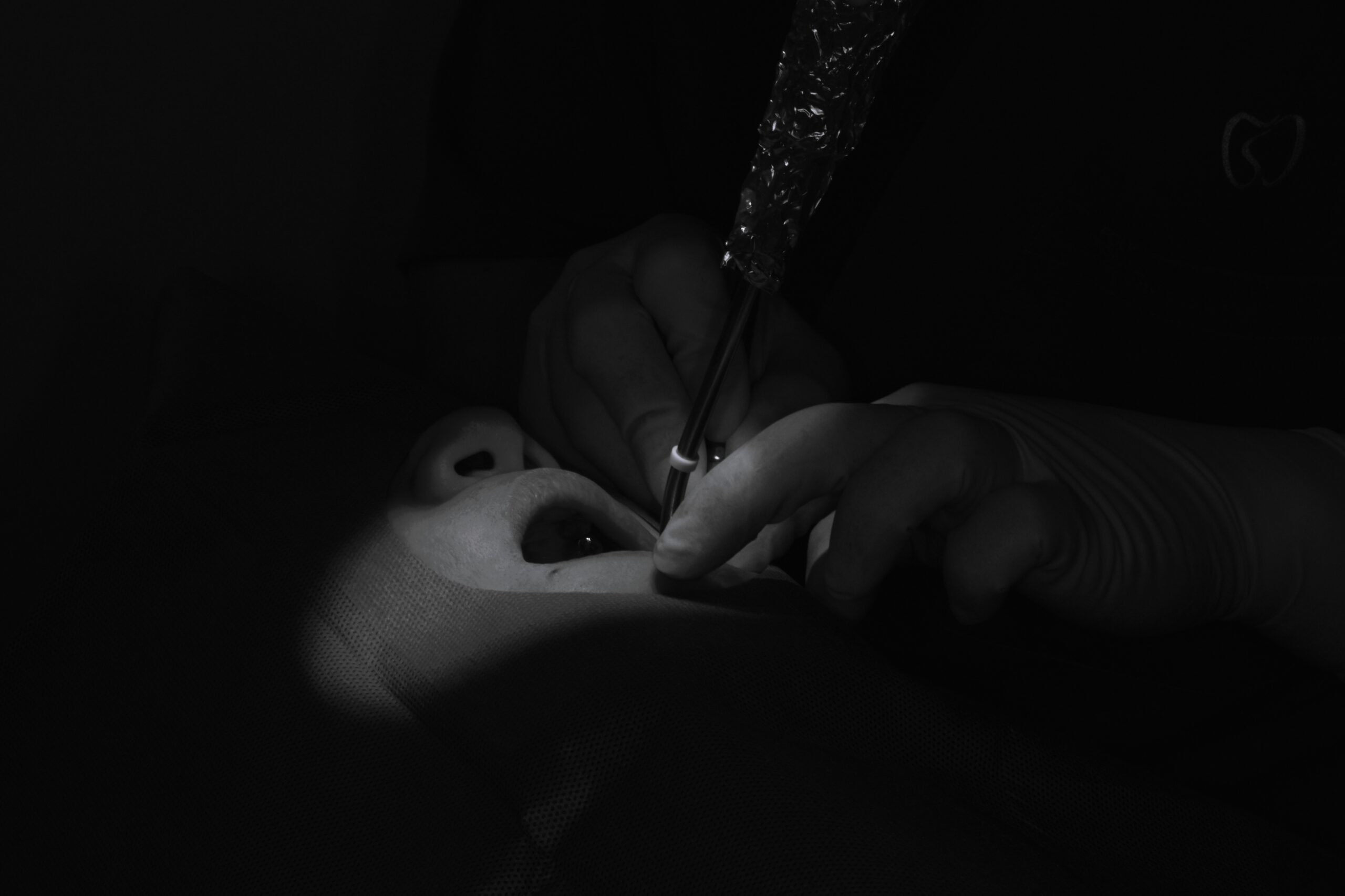 左下6番インプラント一次埋入オペ＃087 画像