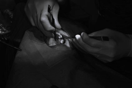 左上6番インプラント一次埋入オペ　＃092 画像